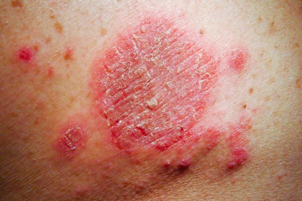 eczema endogena)