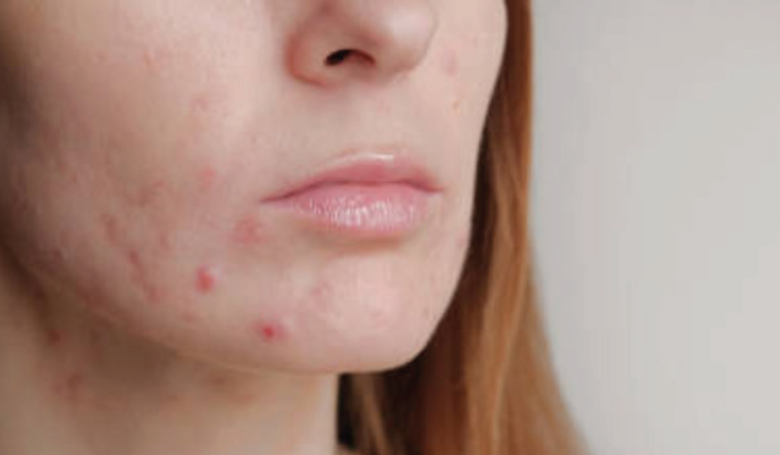 brote #acne #embarazo - Le Mag - Uriage