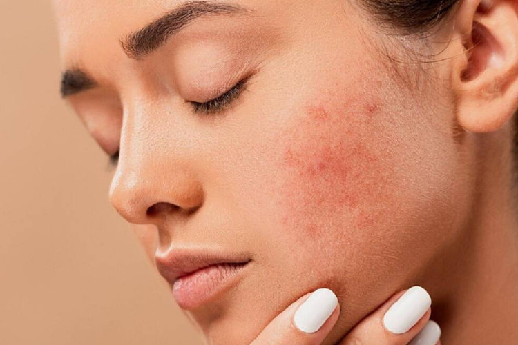 Día Mundial de la Dermatitis Atópica 